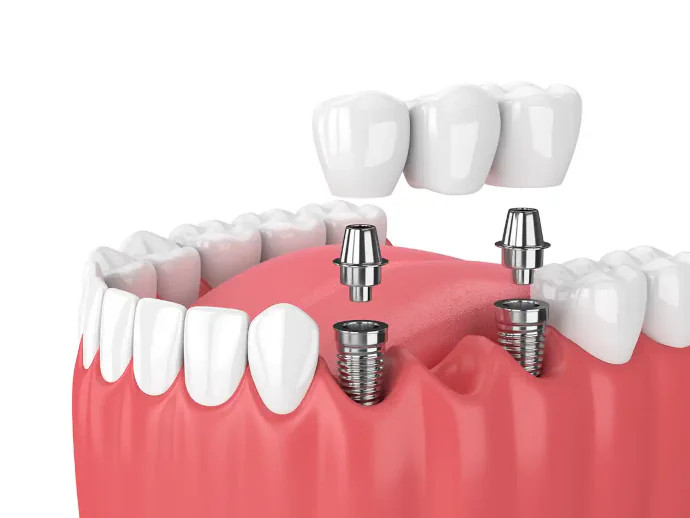 Implant-Supported Bridges