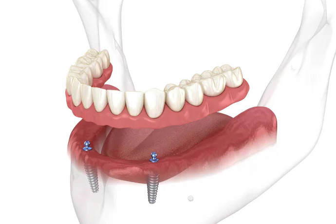 Implant-Supported Dentures